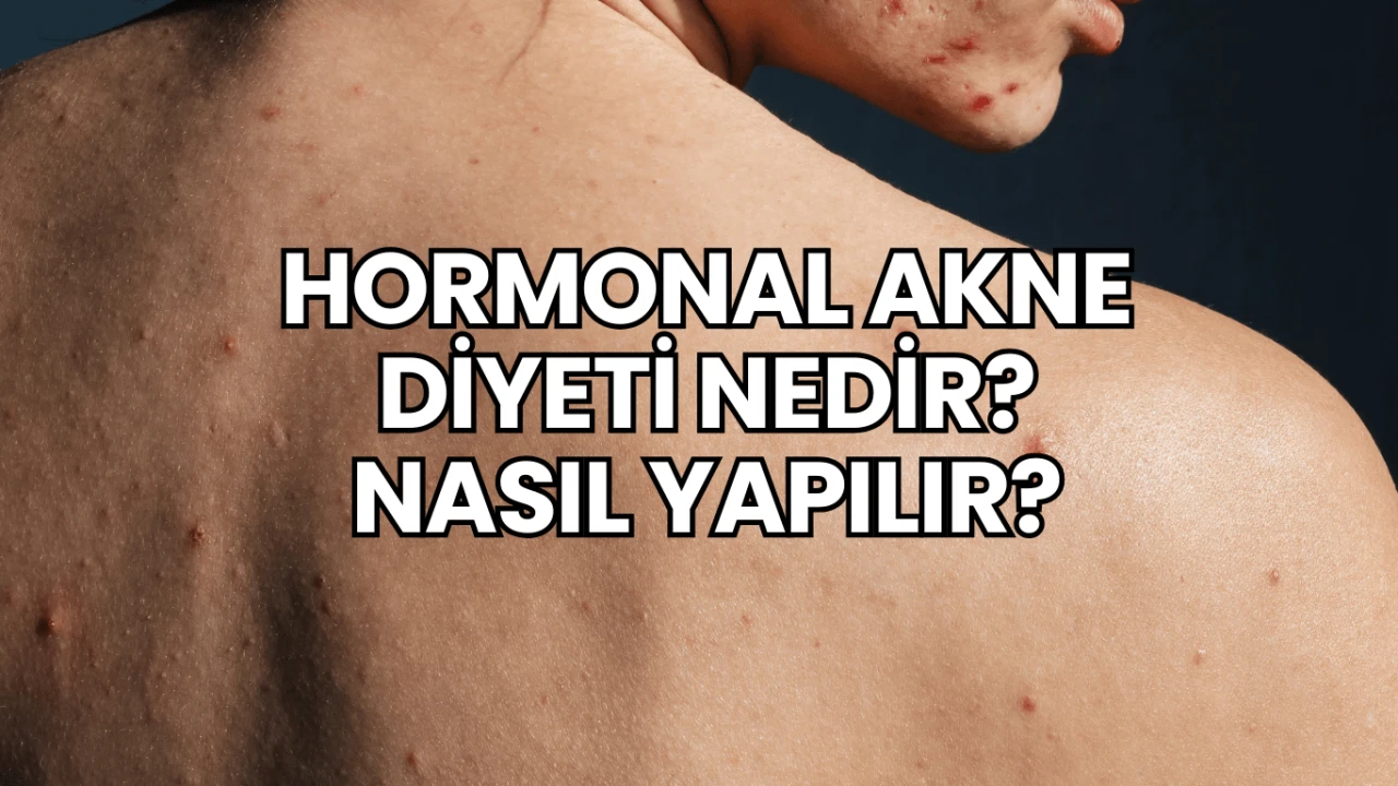 Hormonal Akne Diyeti Nedir? Nasıl Yapılır?