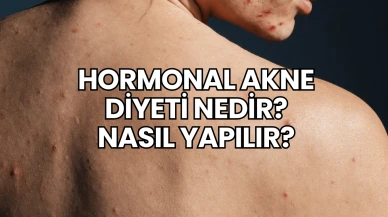 hormonal akne diyeti nedir? nasıl yapılır?